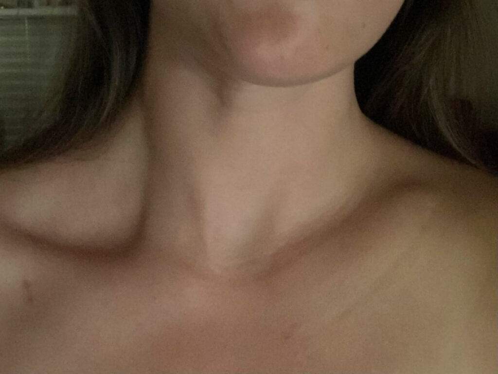Author Betty broken collarbone after the accident