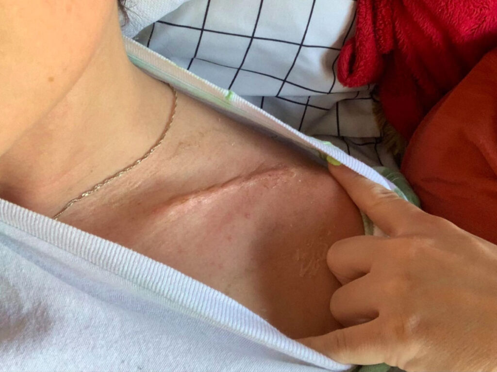 Collarbone post surgery look after a few weeks