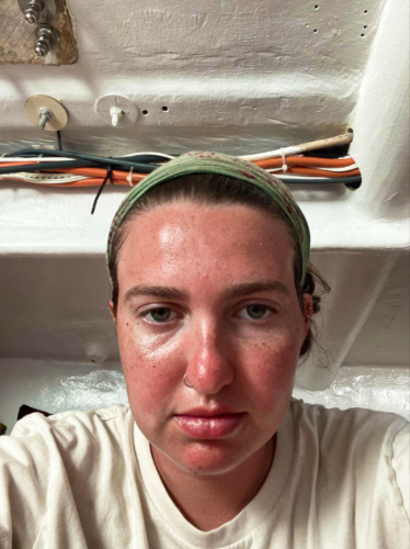 The author Laura McFarland's red face due to sunburned
