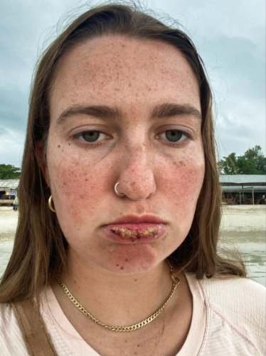 Closeup look of the sunburnt lips of the author, Laura
