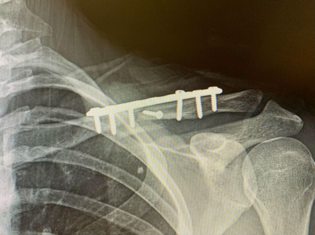 X-ray of author Betty's collarbone with metal plate and seven screws