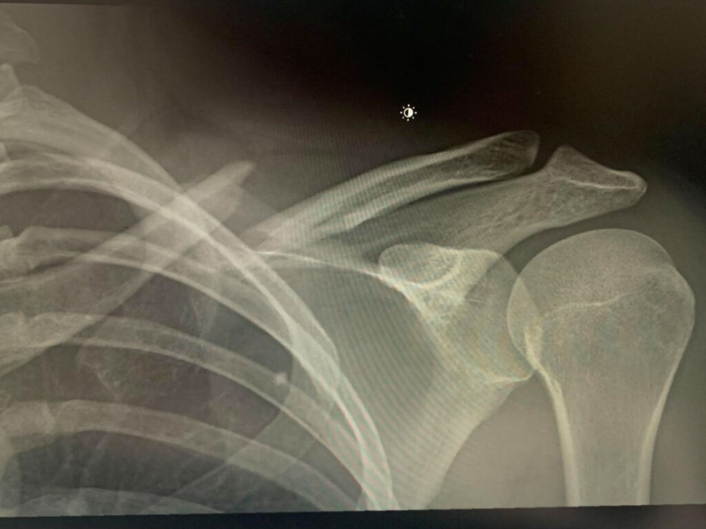 X-ray of the collarbone of author Betty after the accident